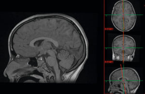 Figure 10.1 MPR : le volume obtenu à partir d'une acquisition sur le crâne en IRM en pondération T1 permet d'analyser les structures cérébrales dans les trois plans de l'espace.