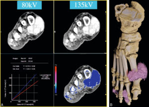 Figure 10.5 TDM en double-énergie du pied droit chez un patient suivi pour une goutte. A. Caractérisation du tophus à partir d'une acquisition à basse énergie (80 kV) et haute énergie (135 kV) et la détermination de sa composition sur chacune de ces acquisitions. B. Global illumination fournissant une cartographie des multiples tophus de l'avant-pied droit.