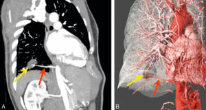 Figure 10.6 Séquestration pulmonaire intralobaire chez un homme de 59 ans. MPR oblique (A) et global illumination (B) après segmentation des vaisseaux et du poumon. La séquestration pulmonaire est une malformation congénitale du poumon où une partie du tissu pulmonaire n'est connecté ni à l'arbre bronchique, ni à la circulation vasculaire pulmonaire. Noter la séquestration (flèche jaune) et son artère nourricière qui naît de l'aorte thoracique descendante (flèche rouge).