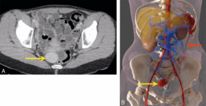 Figure 10.7 Ectopie splénique. Coupe axiale en TDM (A) et global illumination après segmentation des vaisseaux et des différents organes (B). Noter la rate accessoire (flèche jaune) et son long pédicule vasculaire (flèche rouge) dont la topographie contribue au diagnostic. L'ectopie splénique ou « rate baladeuse » se définit comme la migration de la rate dans n'importe quel quadrant de l'abdomen. Elle peut être asymptomatique, de découverte fortuite ou responsable de douleurs abdominales en cas d'épisodes de torsion ou d'infarctus splénique.