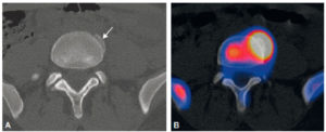 Figure 10.8 Tomoscintigraphie avec TDM (A) et image de fusion d'une tomoscintigraphie osseuse et TDM (B) d'un syndesmophyte dans le cadre d'une spondylarthrite ankylosante. La TDM montre l'anomalie morphologique (flèche). L'image de fusion montre l'activité ostéoblastique qui lui est associée.