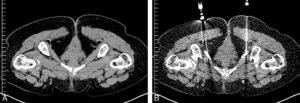 Figure 15.1 Coupes axiales de scanner avant (A) et après injection de repérage (B) dans le canal obturateur ou d’Alcock (dédoublement de l’aponévrose du muscle obturateur interne) permettant l’injection d’anesthésiques locaux et d’anti-inflammatoires à visée antalgique dans le cadre de douleurs périnéales (névralgie pudendale).