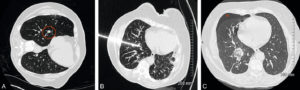 Figure 15.2 Patiente suivie pour une tumeur digestive avec métastase pulmonaire unique (TDM de repérage, cercle rouge) (A) traitée par radiofréquence (B). TDM de contrôle (C) après 24 heures montrant la plage de destruction (ablathermie) satisfaisante et une lame de pneumothorax (astérisque) spontanément résolutive.