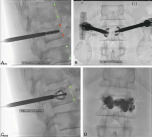 Figure 15.3 Patient présentant un tassement traumatique du corps de la vertèbre L1. Repérage fluoroscopique de profil (A) (flèche rouge) et de face (B) lors de l’insertion transpédiculaire du dispositif d’expansion vertébrale. Ce dispositif d’expansion vertébrale permet de restaurer une hauteur satisfaisante (flèche verte) (C) avant injection complémentaire de ciment (D).