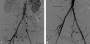 Figure 15.4 Patient présentant une claudication intermittente gauche avec un périmètre de marche limité. L’artériographie avec soustraction osseuse objective une occlusion de l’artère iliaque commune gauche (ligne pointillée en A) suppléée par des collatérales pelviennes. Contrôle après recanalisation par dilatations et stents (B).