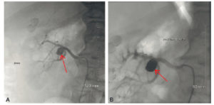 Figure 15.5 Patient présentant un anévrisme sacciforme de la bifurcation de l’artère rénale droite (A, flèche) traité par embolisation du sac par coils (flèche) respectant la perméabilité des branches porteuses permettant de prévenir le risque de rupture et de conserver la fonction rénale (B).