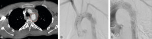 Figure 15.6 Patient adressé pour une rupture traumatique de l’isthme aortique lors d’un accident de voiture. Coupe axiale en TDM injectée (cercle pointillé rouge, A) et artériographie avant (B) et après traitement (C).