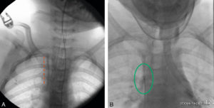 Figure 15.7 Fracture du cathéter d’une chambre implantable lors de son retrait chirurgical. La radiographie thoracique retrouve le fragment en projection du tronc veineux brachiocéphalique droit (ligne pointillée en A). Un cathéter lasso (cercle vert, B) permet la recapture et l’extraction à partir d’une ponction veineuse fémorale droite.