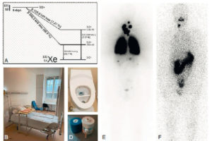 Figure 16.2 Illustration du cas d'un patient présentant un carcinome thyroïdien différencié métastatique aux poumons traité par iode 131. A. Schéma de désintégration de l'iode 131. B. Chambre d'hospitalisation en secteur protégé. C. Sanitaire à deux compartiments permettant le recueil et le stockage des urines radioactives. D. Pot plombé et gélule d'iode 131. E. Balayage corps entier d'une scintigraphie réalisée à J5 d'un premier traitement par 3700 MBq d'iode 131 chez un patient atteint de cancer thyroïdien montrant des fixations anormales pulmonaires (aspect de miliaire pulmonaire) et cervicales (adénopathies cervicales persistantes après chirurgie). F. Balayage corps entier chez le même patient réalisé à J5 d'un second traitement par iode 131, 6 mois après le précédent et après exérèse chirurgicale des adénopathies cervicales, montrant la rémission complète au niveau pulmonaire et une fixation physiologique gastroduodénale.