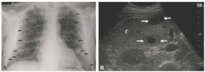 Figure 17.1 Visualisation directe de tumeurs. A. Radiographie thoracique. De multiples nodules (flèches) sont visibles dans les deux poumons sous la forme d'opacités bien limitées de tailles variables. Ces nodules de tonalité hydrique (tissulaire) sont visibles au sein du poumon car ils contrastent avec la clarté aérique du poumon normal. Il s'agit d'une image en « lâcher de ballons » évocatrice de métastases pulmonaires. B. Coupe transverse en échographie mode B du segment VI du foie (F) au sein duquel on visualise deux lésions suspectes de métastases (flèches) dont l'échogénicité contraste avec l'échogénicité environnante du foie. La lésion supérieure est hypoéchogène homogène. La lésion inférieure présente l'aspect typique « en cible » avec un centre hypoéchogène, une couronne isoéchogène au parenchyme hépatique et une limite périphérique hypoéchogène.