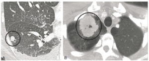 Figure 17.2 Nodules et masses pulmonaires en TDM. A. Coupe axiale en TDM, image centrée sur le lobe inférieur droit. Un nodule (cercle noir) est visible sous la forme d'une hyperdensité ronde au sein du poumon aéré hypodense. B. Coupe axiale en TDM au niveau des apex. Une masse (cercle noir) du lobe supérieur droit mesurant 6 cm est visible sous la forme d'une hyperdensité à bords spiculés au sein du poumon hypodense.