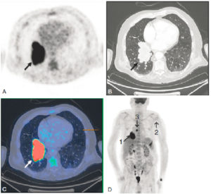 Figure 17.3 Acquisition multimodale. TEP/TDM (coupes transverses). TEP au 18F-FDG (A), TDM (B), fusion TDM-TEP (C) et projection 3D de la biodistribution du 18F-FDG (D). Caractérisation d'une masse tumorale pulmonaire lobaire inférieure droite (B, flèche noire). Hyperfixation très intense du 18F-FDG (A, flèche noire ; C, flèche blanche) de la lésion tumorale pulmonaire orientant vers un carcinome. L'analyse de la biodistribution du 18F-FDG sur l'ensemble de l'acquisition (D) permet de réaliser le bilan d'extension. Noter les hyperfixations localisées sur la tumeur primitive (1) et sur l'adénopathie médiastinale rétrocarénaire (3), la tête humérale gauche (2) et la 10e côte gauche, témoignant respectivement d'une atteinte locorégionale lymphatique et d'une atteinte osseuse. La biopsie de la lésion pulmonaire montrera l'existence d'un adénocarcinome pulmonaire.