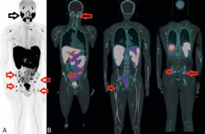 Figure 17.4 Acquisition multimodale. TEP/TDM (coupes frontales). TEP au 68Ga-PSMA : TEP projection 3D (A), fusion TDM-TEP (B). Bilan d'extension de récidive d'un adénocarcinome prostatique. Hyperfixation très intense de nombreuses lésions osseuses secondaires (flèches rouges). Noter l'hyperfixation physiologique du traceur sur les glandes salivaires (flèche noire). La fixation intense des lésions osseuses est expliquée par une forte expression des récepteurs PSMA présents à la surface des cellules tumorales.