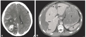 Figure 17.5 Signes indirects d'une tumeur : syndrome de masse. A. Coupe axiale en TDM cérébrale. Une masse cérébrale prenant le contraste (flèche) entraîne un œdème en doigt de gant (E) responsable d'un syndrome de masse sur le ventricule latéral homolatéral et effaçant les sillons corticaux. Seul le ventricule controlatéral (V) est visible. B. Coupe axiale en TDM de l'abdomen. Le patient est porteur d'une tumeur péritonéale qui entraîne un effet de masse (flèches noires), refoulant le bord latéral du foie (F) et élargissant le ligament falciforme (flèches en pointillé). E : estomac, R : rate.