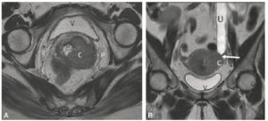 Figure 17.6 Signes directs (A) et indirects (B) d'une tumeur : syndrome obstructif. A. Coupe axiale en IRM en pondération T2 centrée sur le col utérin. Un cancer du col est visible sous la forme d'une lésion en signal intermédiaire (C) envahissant le paramètre gauche (P). V : vessie. B. Coupe coronale en IRM en pondération T2 centrée sur le bassin. L'uretère gauche (U) est sténosé (flèche) à hauteur du paramètre gauche car envahi par le cancer du col (C), et dilaté en amont de la compression, visible sous la forme d'un canal à contenu liquidien en hypersignal T2 franc.