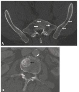Figure 17.7 A. Métastases osseuses lytiques du bassin chez un patient porteur d'un cancer du rein. Les lésions (flèches) apparaissent sous la forme de lacunes (hypodensités) de la trame osseuse. B. Métastase osseuse du corps vertébral de L2 chez un patient porteur d'un cancer de la prostate. La lésion (flèche) apparaît sous la forme d'une condensation focale (hyperdensité) de la trame osseuse.