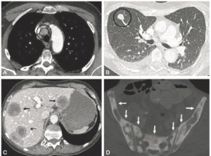 Figure 17.8 Coupes axiales en TDM du thorax en fenêtres médiastinale (A) et pulmonaire (B) de l'abdomen, en fenêtre tissu mou (C) et du bassin en fenêtre osseuse (D) montrant les multiples métastases disséminées chez une patiente porteuse d'un cancer du sein (cercles et flèches).