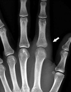 Figure 18.1 Radiographie conventionnelle de la main montrant un épaississement des tissus mous (flèche) chez une patiente ayant une atteinte inflammatoire (polyarthrite rhumatoïde) de l'articulation métacarpophalangienne de l'index.