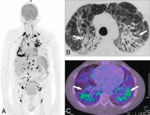 Figure 18.10 Sarcoïdose avec atteinte pulmonaire chronique. A. Image volumique TEP-FDG (3D-MIP) montrant de multiples foyers hypermétaboliques lymphatiques sus- et sous-diaphragmatiques (en noir). B. TDM thoracique du même sujet (coupe axiale) montrant une fibrose pulmonaire, avec distorsions bronchiques par rétraction du parenchyme pulmonaire (flèches). C. Le 18FDG (TEP-TDM en coupe axiale) confirme le caractère hypermétabolique de la fibrose pulmonaire (flèches), témoignant d'un processus inflammatoire encore actif.