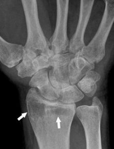Figure 18.2 Radiographie conventionnelle du poignet montrant une déminéralisation inflammatoire (dite « en bande ») (flèches) chez une patiente ayant une atteinte inflammatoire (polyarthrite rhumatoïde) du carpe.