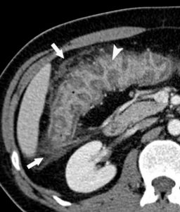 Figure 18.3 TDM abdominale avec injection de produit de contraste chez un jeune patient ayant une atteinte inflammatoire colique (maladie de Crohn) montrant un épaississement et une prise de contraste de la paroi colique (tête de flèche) et une infiltration de la graisse périphérique (flèches).