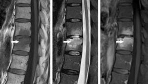 Figure 18.4 IRM de la colonne vertébrale (séquences sagittales T1, T2 et T1 avec injection d'agent de contraste) montrant une atteinte inflammatoire des vertèbres T11 et T12 (flèches) chez un patient ayant une atteinte inflammatoire de type spondylarthrite ankylosante : aspect caractéristique de l'inflammation en hyposignal T1, hypersignal T2 avec un rehaussement en T1 après injection d'agent de contraste.