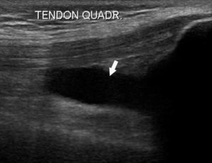 Figure 18.5 Échographie montrant un épanchement (anéchogène) dans l'articulation du genou (flèche) dans le contexte d'une inflammation de la synoviale.