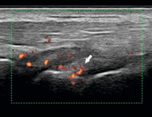 Figure 18.6 Échographie avec Doppler montrant une hypervascularisation (flèche) de la synoviale du poignet chez un patient ayant une atteinte inflammatoire (polyarthrite rhumatoïde) du carpe.