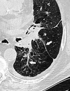 Figure 18.7 TDM thoracique (fenêtre parenchymateuse) montrant des adhérences fibrotiques cicatricielles (flèches).