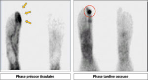 Figure 18.8 Processus ostéoblastique du 1er rayon du pied droit avec composante inflammatoire locorégionale (scintigraphie osseuse au 99mTc des pieds en deux temps). Hyperhémie des parties molles de l'orteil droit en phase précoce (A, flèches), témoignant d'une composante inflammatoire locorégionale du processus osseux d'intérêt, visualisé en phase osseuse (B, hyperfixation focale, cercle).