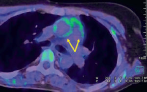 Figure 18.9 Maladie de Takayasu (vascularite des gros vaisseaux)/stade inflammatoire actif (TEP-TDM au 18F-FDG en coupe axiale de l'artère pulmonaire). Hypermétabolisme des parois de l'aorte ascendante et du tronc pulmonaire (flèches), témoignant de l'inflammation active des parois artérielles.