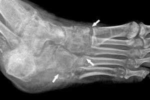 Figure 19.1 Déminéralisation infectieuse du médio-pied en radiographie. Radiographie oblique du pied droit chez un patient avec une arthrite septique montrant une diminution diffuse de la densité du médio-pied par rapport aux métatarses (flèches) et une mauvaise visualisation des contours des os (perte de définition de l'os cortical).