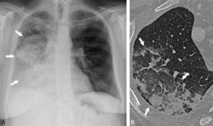 Figure 19.2 Pneumopathie infectieuse droite. Radiographie de face (A) et TDM thoracique en coupe axiale (B) montrant des opacités parenchymateuses liées au remplissage des alvéoles par l'œdème (flèches). Le contraste spontané entre air et œdème (densité hydrique) permet la visualisation directe des anomalies pulmonaires aussi bien en radiographie qu'en TDM.