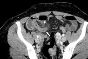 Figure 19.3 Appendicite en TDM. TDM abdominale avec injection de produit de contraste montrant un appendice œdématié, élargi (flèche) avec une infiltration de la graisse adjacente, qui apparaît floue et mal limitée (tête de flèche).