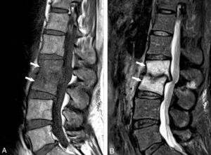 Figure 19.4 Infection discovertébrale (spondylodiscite infectieuse) L3/L4. IRM en coupe sagittale en séquence T1 (A) et T2 (B). L'œdème vertébral leur donne un hyposignal en T1 et un hypersignal T2 (flèches). L'atteinte de deux corps vertébraux adjacents d'un disque avec la présence d'érosions est évocatrice de spondylodiscite infectieuse.