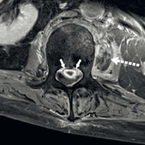 Figure 19.5 Abcès dans l'espace épidural suite à une spondylodiscite infectieuse en IRM. Coupe IRM axiale en séquence T1 avec injection de produit de contraste montrant une formation nodulaire avec un centre en hyposignal (cavité liquidienne) et une prise de contraste périphérique en anneau (flèches) typique d'un abcès ; un autre abcès est visible en paravertébral à gauche (flèche pointillée).