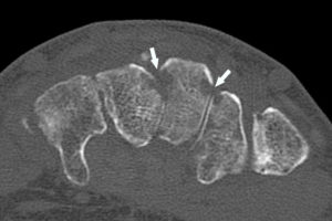 Figure 19.6 Érosions osseuses en TDM. TDM du poignet (coupe axiale) montrant des ostéolyses focales (flèches) chez un patient avec une arthrite septique.