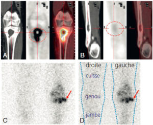 Figure 19.7 MRP généralistes. A, B. TEP-TDM au 18 F-FDG. Ostéomyélite bifocale avec récidive infectieuse chez un enfant. Intense consommation cellulaire de glucose en périphérie de la lacune osseuse de la métaphyse tibiale supérieure gauche (cercle), signant l'évolutivité de l'ostéomyélite à ce niveau (A). Le coté controlatéral (B) ne montre pas de reprise évolutive avec une lacune osseuse séquellaire (cercle). C, D. Scintigraphie aux leucocytes marqués (111In-oxinate). Infection de prothèse totale de genou avec accumulation de leucocytes marqués en périphérie de la pièce tibiale de la prothèse (flèche, vue antérieure). E, F. TEP-TDM au 18 F-FDG. Endocardite infectieuse sur prothèses mécaniques valvulaires mitrale et aortique. E. Intense hypermétabolisme glucosé (flèche) au niveau des prothèses mécaniques (ellipse rouge). F. Embolie septique à distance (flèche) dans le parenchyme pulmonaire.