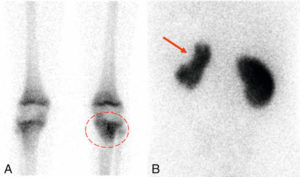 Figure 19.8 MRP spécifiques. A. Scintigraphie osseuse au 99mTc-HMDP. Ostéomyélite tibiale chez un enfant : hyperfixation relative sur la métaphyse tibiale supérieure gauche (entourée, vue antérieure). À noter : la fixation du traceur osseux est également accentuée physiologiquement dans l'ensemble des cartilages de conjugaison. B. Scintigraphie rénale au 99mTc-DMSA. Séquelle fonctionnelle de pyélonéphrite : lacune de fixation corticale supéro-externe du rein gauche (flèche, vue postérieure).