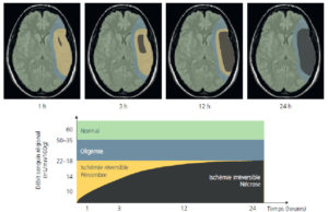 Figure 20.1 Représentation schématique de l'ischémie cérébrale montrant les phases d'apparition de l'oligémie, de la pénombre (ischémie réversible) et de la nécrose.