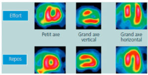 Figure 20.10 Images TEMP au 99mTc-sestamibi montrant un cas d'ischémie myocardique aux phases d'effort (ou stress) et de repos.