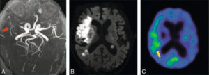 Figure 20.11 IRM et TEP 18F-FMISO dans le cas d'un AVC à J30. L'angio-IRM (A) montre une revascularisation partielle (flèche rouge) et la TEP (C) indique une absence de fixation du traceur dans la zone hyperintense en DWI (B). Néanmoins, une fixation du traceur est visible (flèche jaune), postérieure à la lésion, et évoque une possible hypoxie persistante. Source : Takasawa M, Reda Moustafa R, Baron JC. Applications of nitroimidazole in vivo hypoxia imaging in ischemic stroke. Stroke 2008;39 :1629–37. © Wolters Kluwer 2008.