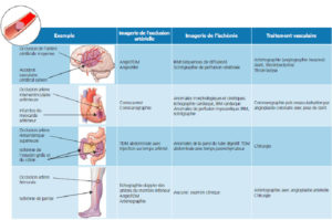 Figure 20.2 Illustration à partir de quatre exemples de l'exploration multimodale en imagerie des processus ischémiques. En fonction des organes atteints et du degré d'urgence, l'une ou l'autre des techniques est privilégiée pour évaluer l'anatomie vasculaire d'une part, et le retentissement sur l'organe d'autre part. Dessins : Cyrille Martinet.