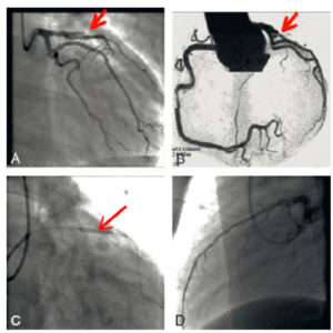 Figure 20.3 Occlusion d'une artère coronaire en angiographie. A. Coronarographie sélective de l'artère coronaire gauche montrant une occlusion brutale de l'artère interventriculaire antérieure par un thrombus (flèche). B. L'occlusion était visible sur le coroscanner (flèche). C. Procédure de revascularisation coronaire par déploiement intracoronaire d'un stent monté sur ballon (flèche). D. Résultat final après désobstruction coronaire et mise en place d'un stent sur l'artère interventriculaire antérieure proximale.