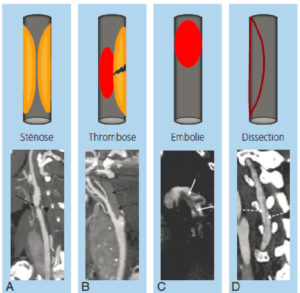 Figure 20.4 Aspects en angio-TDM des principaux types d'occlusion artérielle. TDM réalisées après injection de produit de contraste au temps artériel avec reconstructions en mode MIP montrant la lumière artérielle (hyperdense) partiellement ou complètement oblitérée par une structure hypodense. A. Sténose carotidienne sévère (85 %) sur athérome (flèche noire) circonférentiel partiellement calcifié (tête de flèche). B. Thrombose complète de la carotide interne (flèches noires en pointillés). C. Embolie pulmonaire avec présence de thrombus hypodenses dans la lumière de l'artère pulmonaire gauche en vue sagittale (flèches blanches). D. Dissection d'une artère vertébrale avec visibilité du flap intimal dans la lumière artérielle (flèches blanches pointillées).