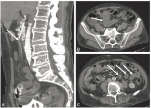 Figure 20.5 Homme de 74 ans, contexte de cholangiocarcinome intrahépatique. Douleurs abdominales intenses motivant la réalisation d'une TDM abdominale. A. Images sagittales MIP au temps artériel précoce objectivant une occlusion complète de l'artère mésentérique supérieure (flèche). B, C. Les coupes axiales au temps portal montrent des anses jéjunales à paroi épaisse et hypodense (flèches), avec une prise de contraste persistante de la muqueuse. Il n'existe pas de signe de complication. Le taux de lactates sériques était normal, et le patient ne présentait pas de défaillance d'organe. Le tout correspond donc à une ischémie mésentérique aiguë d'origine artérielle embolique au stade précoce. Remerciements au Dr Maxime Ronot.