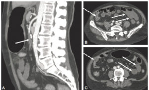 Figure 20.6 Homme de 58 ans. Douleurs abdominales intenses motivant la réalisation d'une TDM abdominale. A. Images sagittales MIP au temps artériel précoce objectivant une occlusion complète de l'artère mésentérique supérieure (flèche). B, C. Les coupes axiales au temps portal montrent des anses jéjunales à paroi fine avec un défaut de rehaussement (flèches), comparé aux anses normales dans le flanc droit (flèches pointillées). Il n'existe pas de signe de complication, mais le taux de lactates sériques était à deux fois la valeur supérieure de la normale. Le tout correspond donc à une ischémie mésentérique aiguë d'origine artérielle embolique au stade tardif. Remerciements au Dr Maxime Ronot.