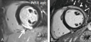 Figure 20.7 Séquences IRM de « rehaussement tardif » (imagerie T1) réalisée 10 minutes après injection d'un agent de contraste à base de chélates de gadolinium, montrant une séquelle de nécrose inféroseptale et inférieure du ventricule gauche dans le cadre d'un infarctus du myocarde (A) (flèche blanche large) atteignant l'endocarde, à différencier d'une myocardite aiguë latérale du ventricule gauche myocardite (B) (flèches blanches fines) où l'atteinte touche l'épicarde et préserve l'endocarde.
