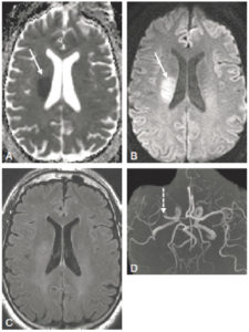 Figure 20.8 IRM cérébrale à 2 heures de l'apparition d'un déficit hémicorporel gauche. Une cartographie du coefficient apparent de diffusion (A) et une image native de diffusion (B) montrent une zone d'ischémie limitée au territoire cérébral moyen (ou sylvien) profond (flèches blanches). L'image morphologique en pondération fluid-attenuated inversion recovery (FLAIR) dans le plan axial (C) au même niveau ne montre pas d'anomalie. L'angio-IRM (D) sans injection (3D-time of flight [TOF] en reconstruction MIP) montre une occlusion de l'artère cérébrale moyenne droite (flèche en pointillés). Remerciements au Pr Kremer.