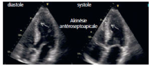 Figure 20.9 Échographie du cœur dans le plan 4 cavités montrant un segment du septum interventriculaire apical dont l'épaississement en systole est insuffisant (flèche), définissant une hypokinésie à ce niveau. Il s'agit de la conséquence fonctionnelle ici d'un infarctus du myocarde antéro-septo-apical incomplet. En revanche, l'échographie ne permet pas ici, contrairement à l'IRM, une caractérisation tissulaire.